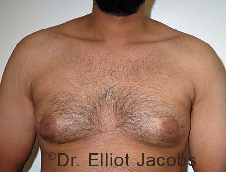 Male breast, before Gynecomastia treatment, front view, patient 104