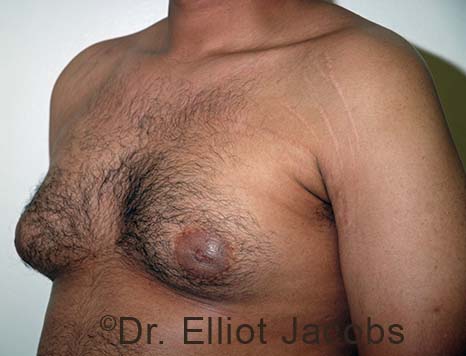 Male breast, before Gynecomastia treatment, l-side oblique view - patient 104