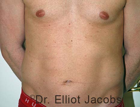 Male body, before Torsoplasty treatment, front view, patient 29