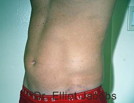 Male body, before Torsoplasty treatment, l-side oblique view, patient 29