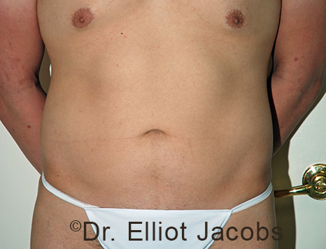 Male body, before Torsoplasty treatment, front view, patient 30