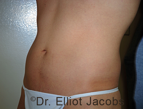 Male body, before Torsoplasty treatment, l-side oblique view, patient 30