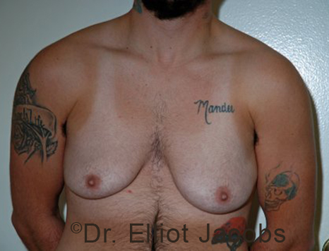 Gynecomastia. Male breast, before FTM Top Surgery treatment, front view, patient 9