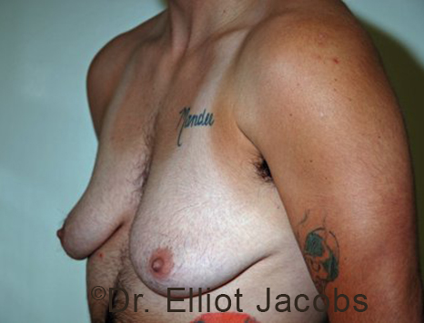 Gynecomastia. Male breast, before FTM Top Surgery treatment, l-side oblique view, patient 9