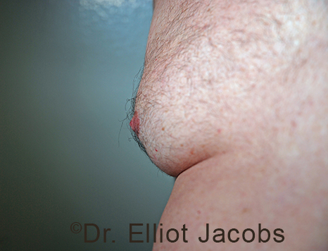 Male nipple, before Puffy Nipple treatment, oblique view - patient 52