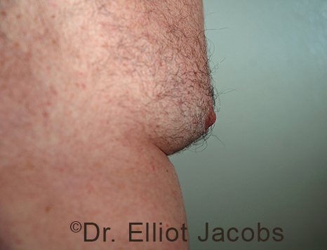Male nipple, before Puffy Nipple treatment, side view - patient 52