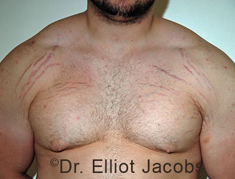 Male breast, after Gynecomastia treatment, front view, patient 105