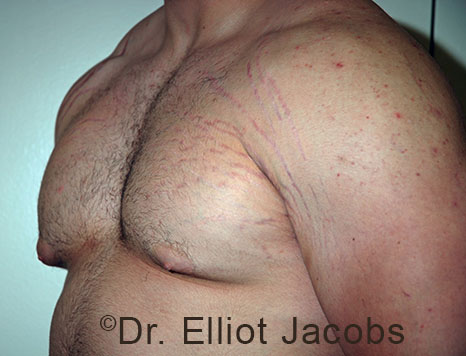 Male breast, before Gynecomastia treatment, l-side oblique view - patient 105