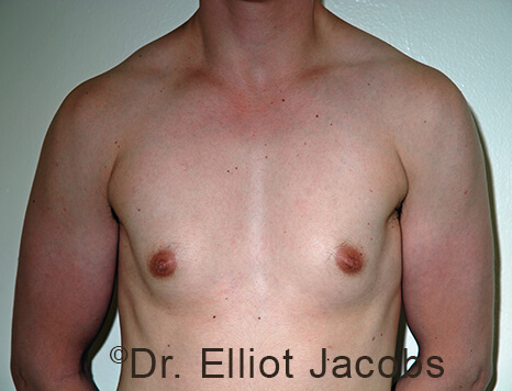 Gynecomastia. Male breast, before FTM Top Surgery treatment, front view, patient 10
