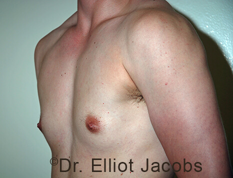 Gynecomastia. Male breast, before FTM Top Surgery treatment, l-side oblique view, patient 10