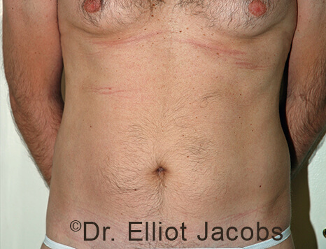 Male body, before Torsoplasty treatment, front view, patient 31