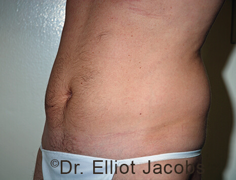 Male body, before Torsoplasty treatment, l-side oblique view, patient 31