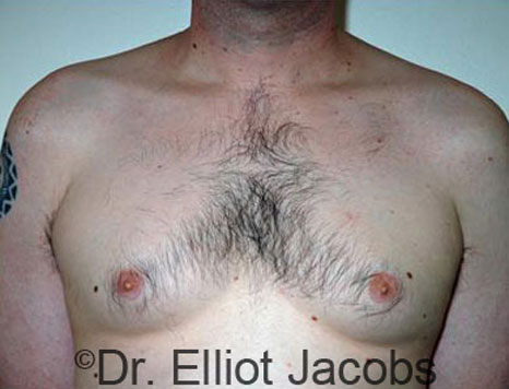 Male breast, before Gynecomastia treatment, front view, patient 29