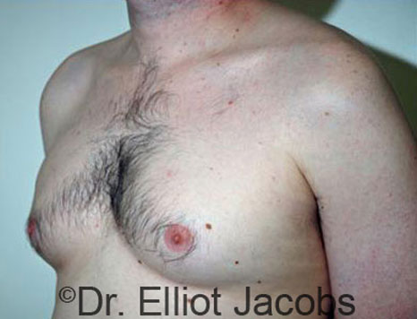 Male breast, before Gynecomastia treatment, l-side oblique view - patient 29