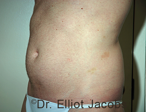 Male body, before Torsoplasty treatment, l-side oblique view, patient 32