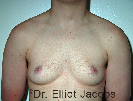 Gynecomastia. Male breast, before FTM Top Surgery treatment, front view, patient 11