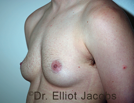 Gynecomastia. Male breast, before FTM Top Surgery treatment, l-side oblique view, patient 11