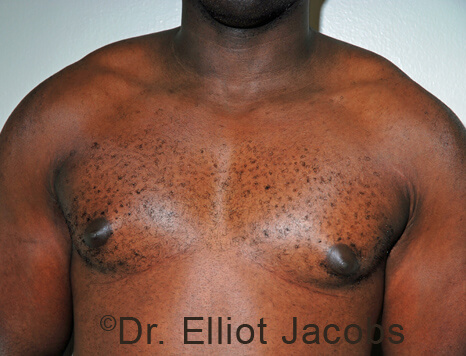 Male breast, before Gynecomastia treatment, front view, patient 106