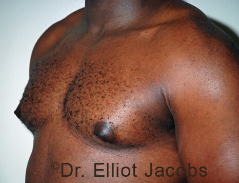 Male breast, before Gynecomastia treatment, l-side oblique view - patient 106