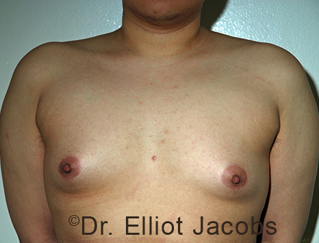 Gynecomastia. Male breast, before FTM Top Surgery treatment, front view, patient 12