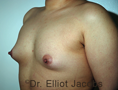 Gynecomastia. Male breast, before FTM Top Surgery treatment, l-side oblique view, patient 12