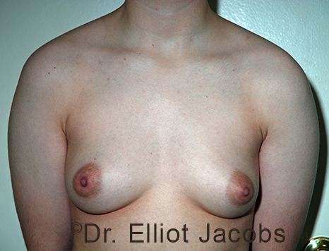 Gynecomastia. Male breast, before FTM Top Surgery treatment, front view, patient 13
