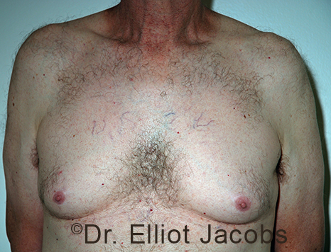 Male breast, before Gynecomastia treatment, front view, patient 107