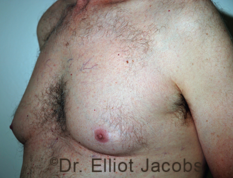 Male breast, before Gynecomastia treatment, l-side oblique view - patient 107