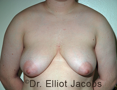 Gynecomastia. Male breast, before FTM Top Surgery treatment, front view, patient 14