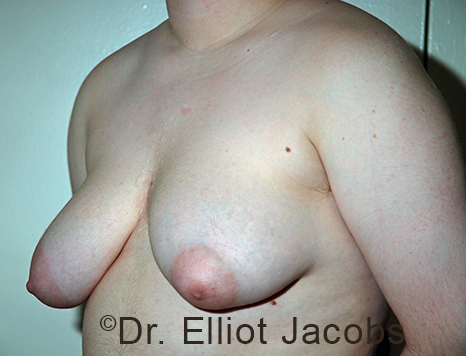 Gynecomastia. Male breast, before FTM Top Surgery treatment, l-side oblique view, patient 14