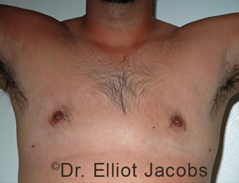 Men's breast, before Crater Deformity Repair treatment, front view - patient 5