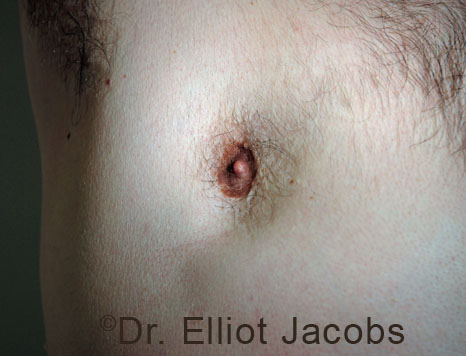 Men's breast, before Crater Deformity Repair treatment, front view, patient 5