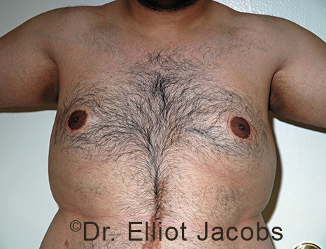 Male breast, before Gynecomastia treatment, front view, patient 108