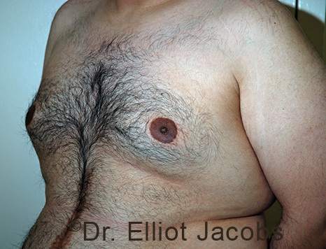 Male breast, before Gynecomastia treatment, l-side oblique view - patient 108