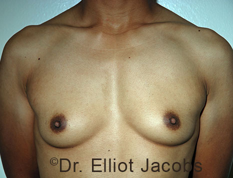 Gynecomastia. Male breast, before FTM Top Surgery treatment, front view, patient 15