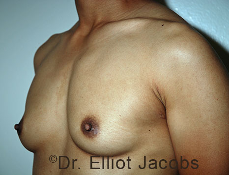 Gynecomastia. Male breast, before FTM Top Surgery treatment, l-side oblique view, patient 15