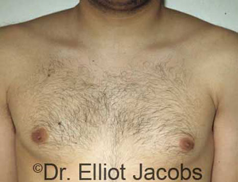 Male breast, before Gynecomastia treatment, front view, patient 3