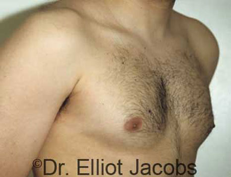 Male breast, before Gynecomastia treatment, r-side oblique view, patient 3