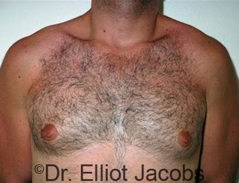 Male breast, before Gynecomastia treatment, front view, patient 30