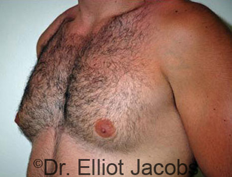 Male breast, before Gynecomastia treatment, l-side oblique view - patient 30