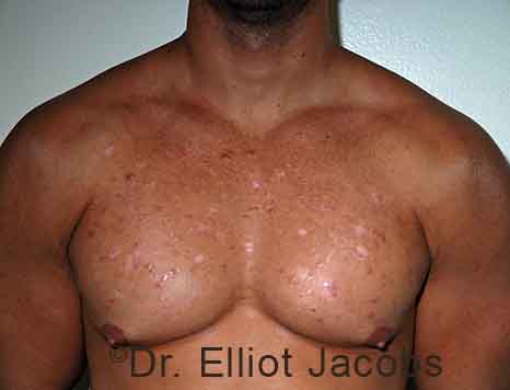 Male breast, before Gynecomastia treatment, front view, patient 109