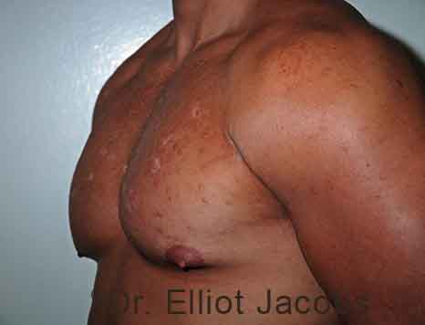 Male breast, before Gynecomastia treatment, l-side oblique view - patient 109