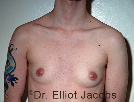 Gynecomastia. Male breast, before FTM Top Surgery treatment, front view, patient 16
