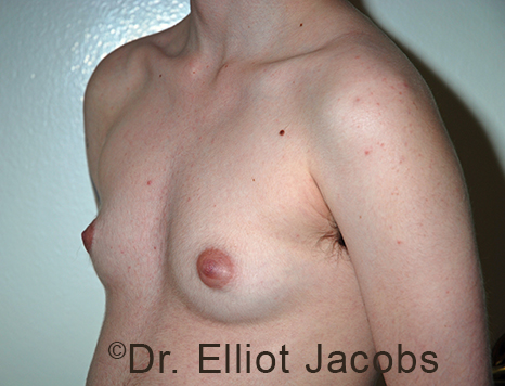 Gynecomastia. Male breast, before FTM Top Surgery treatment, l-side oblique view, patient 16