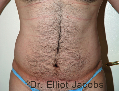 Male body, before Torsoplasty treatment, front view, patient 33