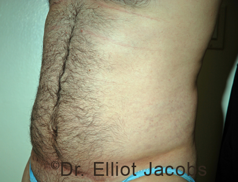 Male body, before Torsoplasty treatment, l-side oblique view, patient 33