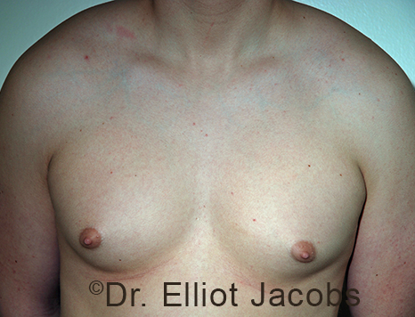 Men's breast, before Gynecomastia Adolescent treatment, front view - patient 37