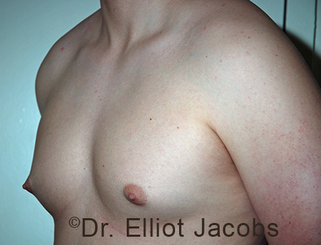 Men's breast, before Gynecomastia Adolescent treatment, oblique view - patient 37