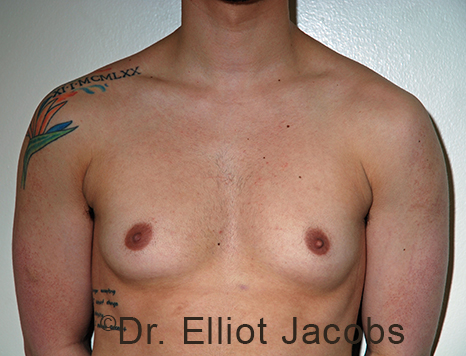 Gynecomastia. Male breast, before FTM Top Surgery treatment, front view, patient 17