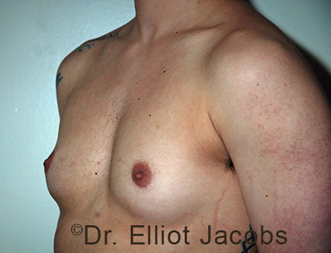 Gynecomastia. Male breast, before FTM Top Surgery treatment, l-side oblique view, patient 17